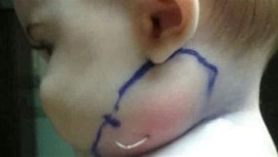 صورة اعتقدت الأم أنها مجرد بثرة لكن عندما فتح الطبيب وسحبها صدم الجميع بما رأوه وحذروا جميع الأمهات