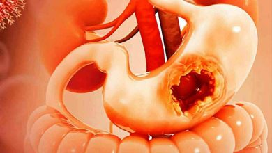 صورة أعراض لسرطان المعدة في مرحلة مبكرة تنبهك لضرورة التوجه إلى الطبيب