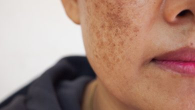 صورة وصفات طبيعية لعلاج الكلف بطرق آمنة في المنزل