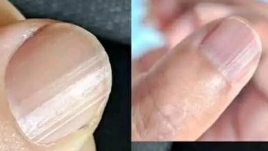 صورة ماذا تعني الخطوط على الأظافر وأسباب ظهورها؟