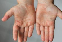 صورة بعد إغلاق عدة مدارس بسبب انتشاره! تعرف على فيرس HFDM وكيفية حماية طفلك منه