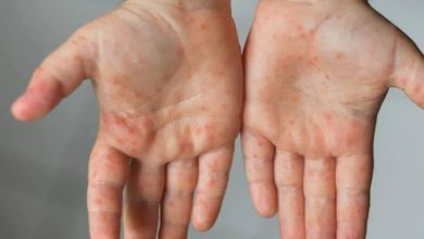 صورة بعد إغلاق عدة مدارس بسبب انتشاره! تعرف على فيرس HFDM وكيفية حماية طفلك منه