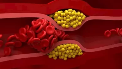 صورة من الرأس إلى القدم: 6 علامات تخبرك بأن كوليسترولك مرتفع
