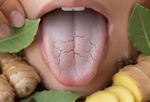 صورة اللسان المتشقق: أسبابه المحتملة وطرق العناية الطبيعية